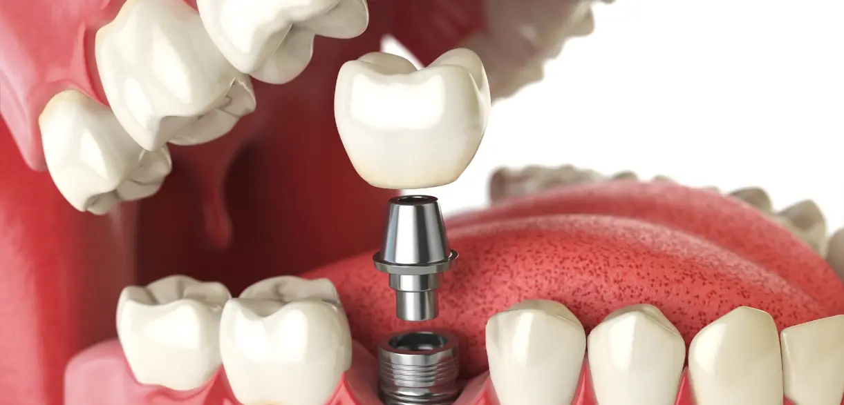 Are Dental Implants The Best Tooth Replacement Option? Alief at Wilson Dentistry