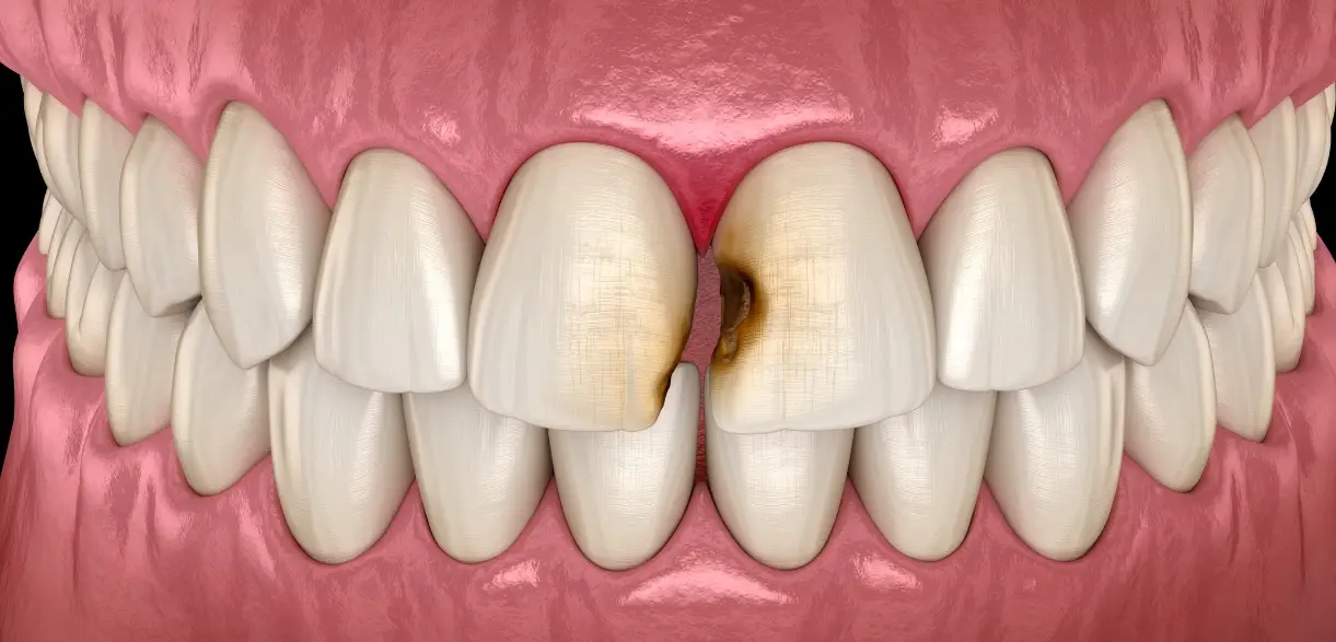 Tooth Abscess Emergency: Symptoms, Risks & When to Seek Help Luxury dental care in Katy