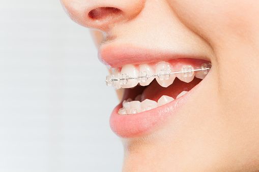 Tips for Maintaining Your Dental Braces