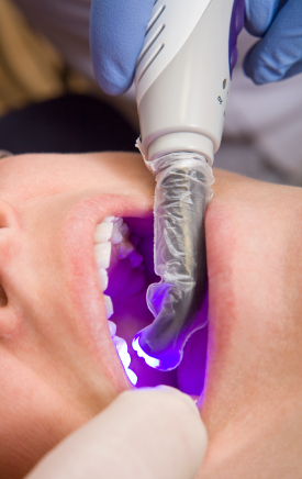 What are The Different Types of Fillings