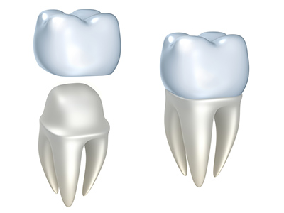 What Is The Best Dental Crown For Me