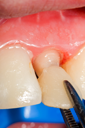 What are the benefits of Veneers and Braces