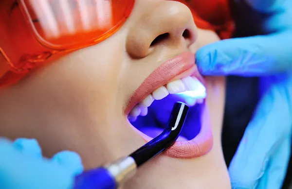 Dental Sealants for Cavity Prevention