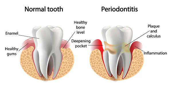 My Teeth Seem To Be Getting Longer and Larger. Should I Worry