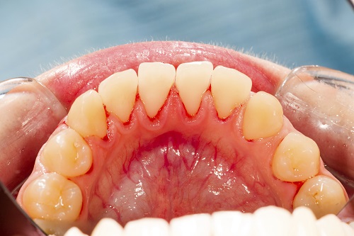 Dangers of Periodontitis