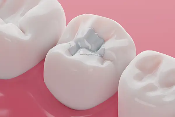 Do Your Fillings Need to Be Replaced