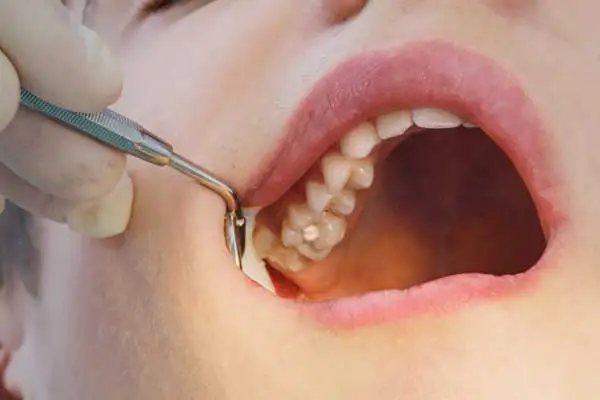 How To Tell When Your Filling Needs To Be Replaced