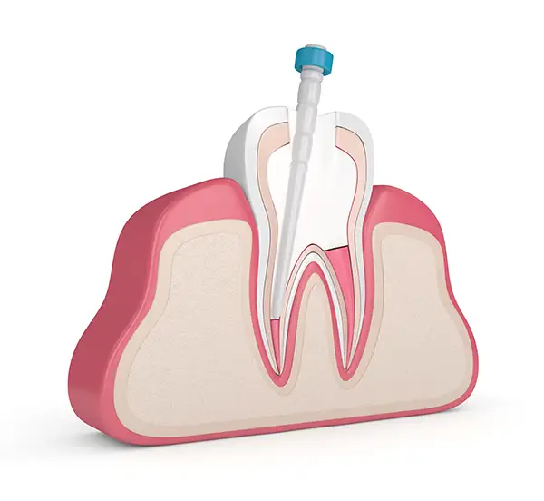 Why You Should Look Forward to It If You Need a Root Canal