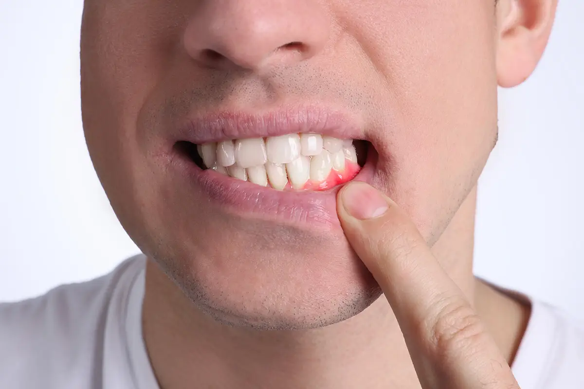 Bleeding Gums or Mouth Injury: When Is Oral Bleeding a Dental Emergency in Katy, TX?